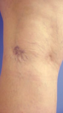 Before and after results of Microsclerotherapy